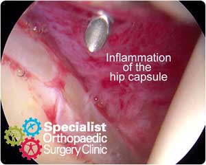 ar-capsulitis01-300