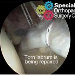 Hip arthroscopy - labral repair