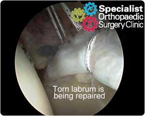 ar-labral-repair02-300