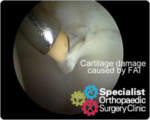 ar-rim-lesion02-300