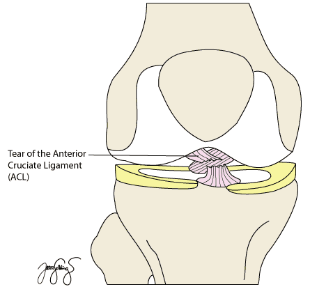 di-acl-tear-c-label