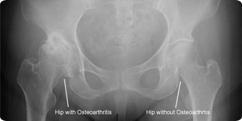 Anterior Hip Replacement - SOS Clinic